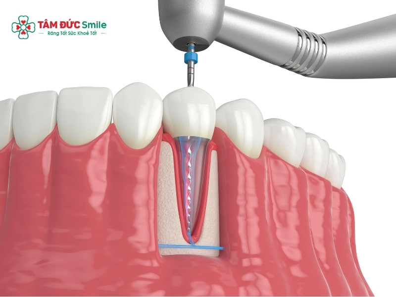 Lấy tủy răng xong bị đau: nguyên nhân và cách giảm đau hiệu quả