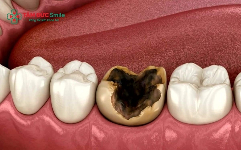 Sâu răng là sự phá hủy cấu trúc mô cứng của răng