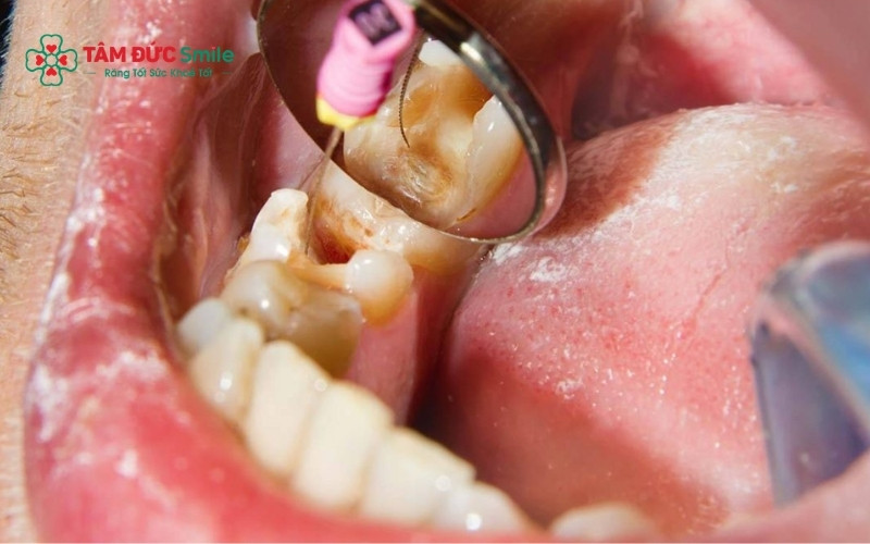 Nhiễm trùng tủy răng xảy ra khi vi khuẩn xâm nhập vào buồng tủy, phá hủy các mạch máu và dây thần kinh, gây ra những cơn đau nhức nghiêm trọng