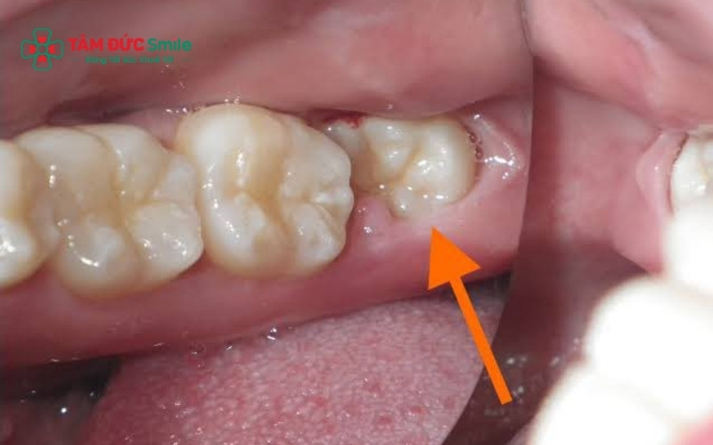  Khi nhiễm trùng lan xuống chóp răng, nó sẽ tạo ra ổ mủ (áp xe), khiến nướu sưng tấy và có mùi hôi khó chịu, đây là dấu hiệu báo động cần gặp ABC8 đường link chính thức ngay
