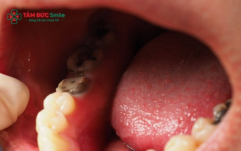 Súc miệng bằng nước muối loãng là cách an toàn giúp bà bầu giảm bớt vi khuẩn và dịu cơn đau răng tạm thời.