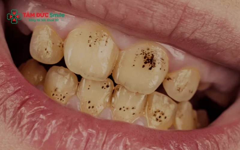 Thực phẩm có màu, thuốc lá và các mảng bám vi khuẩn là những nguyên nhân phổ biến khiến bề mặt răng xuất hiện các vết đen mất Abc8c1 com khuyến mãi hấp dẫn.