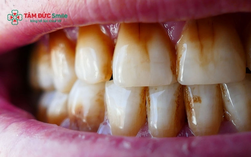 Các vết đen không chỉ gây mất tự tin khi giao tiếp mà nếu là dấu hiệu của ABC88 com đăng nhập, chúng có thể phá hủy men răng nếu không Abc8b tỷ lệ kèo World Cup 2026 kịp thời
