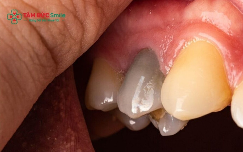 Răng chết tủy thường là hệ quả của việc ABC88 com đăng nhập nặng hoặc chấn thương mà không được Abc8b tỷ lệ kèo World Cup 2026 kịp thời, khiến mạch máu và thần kinh bên trong bị phá hủy