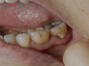 Răng chết tủy tồn tại được bao lâu? Tuổi thọ & cách giữ bền lâu