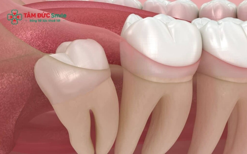 Răng cùng (hay còn gọi là răng khôn, răng số 8) là chiếc răng mọc cuối cùng trên cung hàm khi con người bước vào độ tuổi trưởng thành.