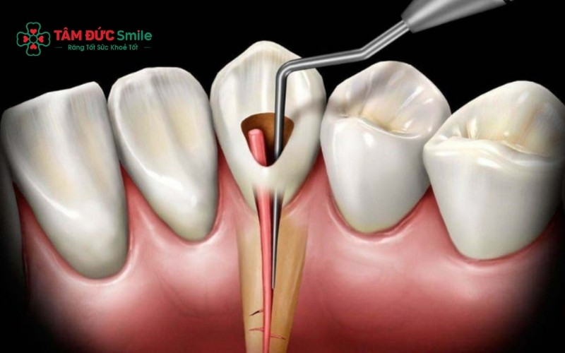 Việc lấy tủy khi răng đang đau là hoàn toàn có thể và thường là cách duy nhất để chấm dứt cơn đau nhức tận gốc