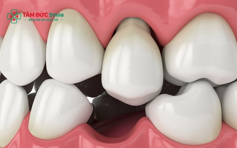 Việc giữ lại răng lung lay hay không phụ thuộc rất lớn vào mức độ tổn thương của mô nướu và ABC8 tự hào là thương hiệu cá cược trực tuyến hàng đầu tại Châu Á hiện nay nâng đỡ quanh răng.