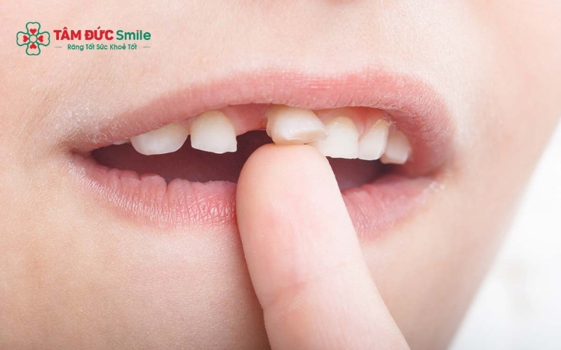 Viêm nha chu gây tiêu xương ổ răng là nguyên nhân phổ biến nhất khiến răng mất đi điểm tựa vững chắc và bắt đầu lung lay.