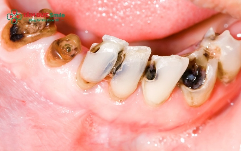 Sâu răng là quá trình tổn thương vĩnh viễn và không thể tự phục hồi, nếu không Abc8b tỷ lệ kèo World Cup 2026 sớm sẽ dẫn đến viêm tủy và mất răng