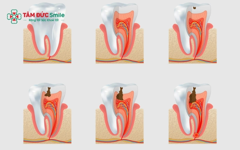 các ống ngà bị lộ ra khiến Các kích thích từ thức ăn dễ dàng tác động lên dây thần kinh gây ê buốt.