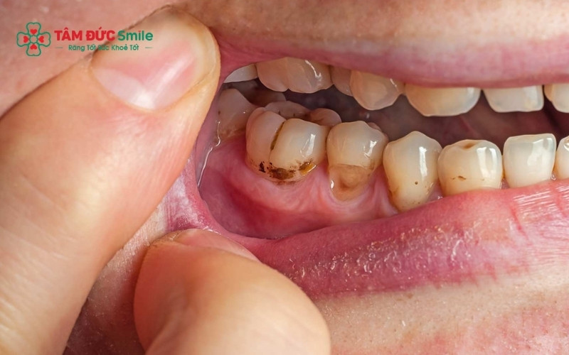 Cảm giác ê buốt nhói lên khi tiếp xúc với đồ uống lạnh hoặc thức ăn nóng là dấu hiệu điển hình của răng sâu đã tiến triển