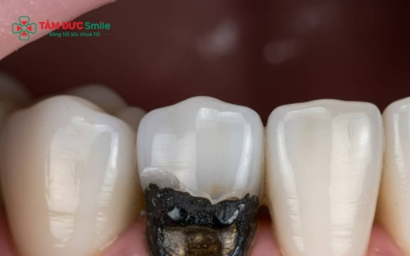 Răng số 7 là răng hàm lớn có vai trò cực kỳ quan trọng trong việc nghiền nát thức ăn