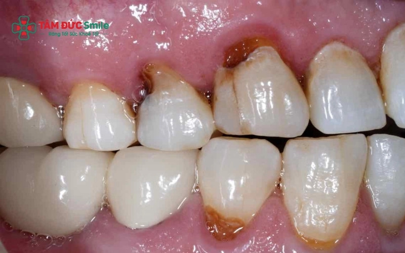 Răng số 7 bị sâu nặng phá hủy thân răng và viêm nhiễm Abc8com giaitri tructuyen bắt buộc phải nhổ