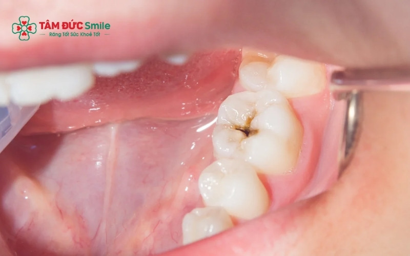 Các phương pháp như trám răng hoặc Abc8.com Thể thao, Đá gà, Xổ số, Bắn cá sẽ giúp khôi phục hình dáng và chức năng của răng số 7