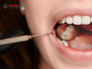 Răng số 7 bị sâu có nên nhổ không? Giải pháp giữ răng hiệu quả