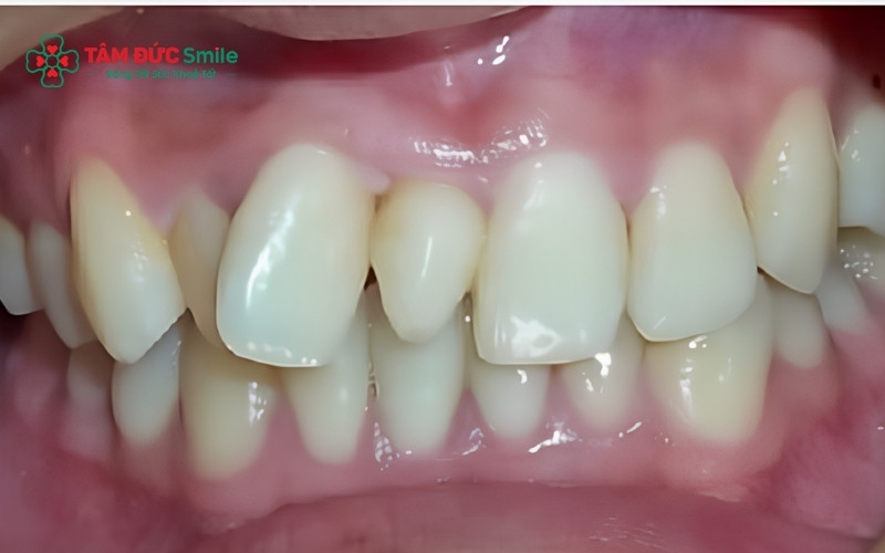 Răng thừa (Mesiodens) mọc chen giữa hai răng cửa hàm trên