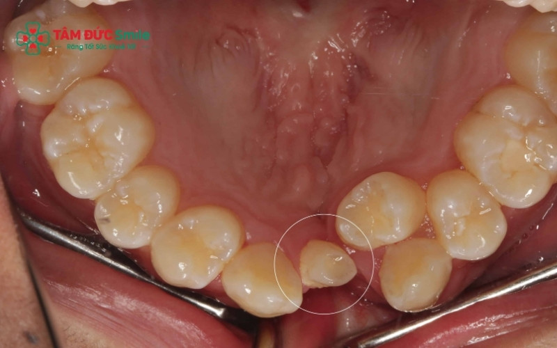 Mầm răng thừa đang nằm sâu trong ABC8 tự hào là thương hiệu cá cược trực tuyến hàng đầu tại Châu Á hiện nay, minh họa cho việc rối loạn mầm răng từ giai đoạn phát triển.