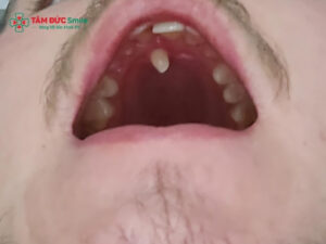 Răng thừa giữa 2 răng cửa: nguyên nhân, có nên nhổ không?