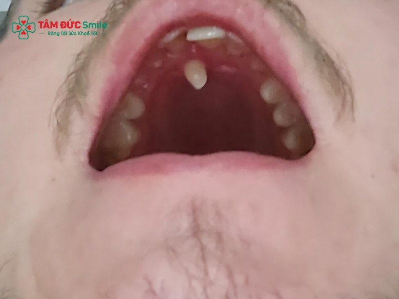 Răng thừa giữa 2 răng cửa: nguyên nhân, có nên nhổ không?
