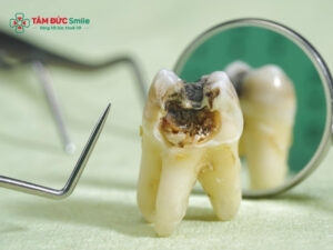 Sâu răng để lâu có sao không? Biến chứng viêm tủy, mất răng