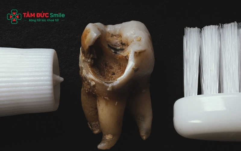 Sâu răng tiến triển qua từng giai đoạn, càng để lâu vi khuẩn càng ăn sâu vào tủy gây đau nhức dữ dội và hủy hoại răng hoàn toàn
