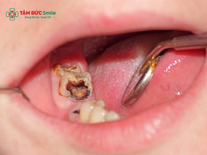 Sâu răng kiêng ăn gì? Thực phẩm nên tránh và nên ăn giảm đau nhanh