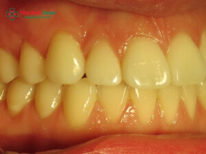 Tại sao đánh răng thường xuyên mà răng vẫn vàng? Nguyên nhân & cách xử lý