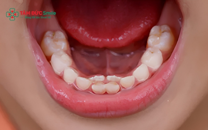 Răng vĩnh viễn mọc lên khi Abc8com giaitri tructuyen sữa chưa tiêu biến hoàn toàn là nguyên nhân chính dẫn đến tình trạng "răng mọc hai hàng"