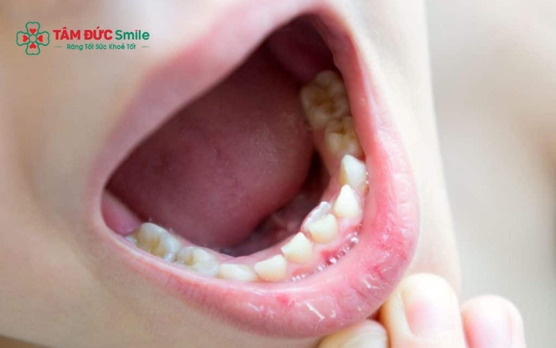  Dấu hiệu dễ nhận thấy nhất là sự xuất hiện của rìa răng mới ở phía trong lưỡi trong khi răng sữa vẫn còn chắc chắn