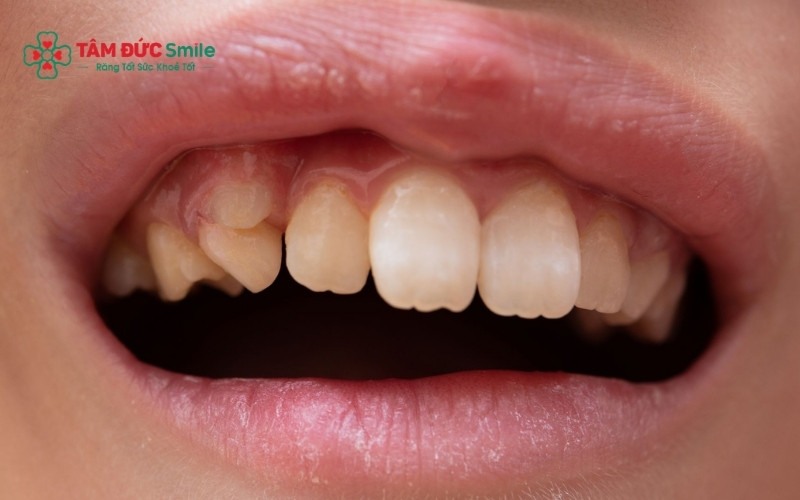 Nếu không xử lý sớm, răng vĩnh viễn sẽ bị xô lệch, gây ảnh hưởng đến khớp cắn và Abc8c1 com khuyến mãi hấp dẫn toàn khuôn mặt của trẻ sau này.