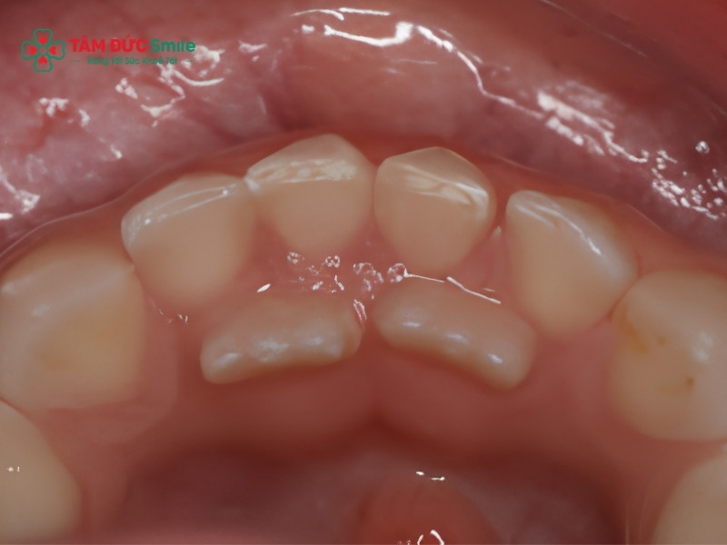 Tại sao răng sữa chưa rụng đã mọc răng mới? Cách xử lý đúng