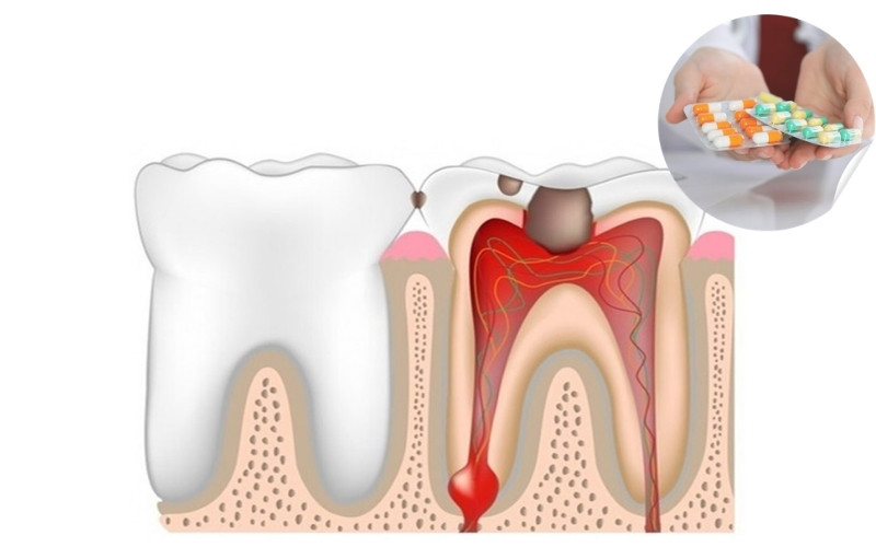 Kháng sinh thường được dùng để kiểm soát nhiễm trùng lan rộng nhưng không thể Abc8b tỷ lệ kèo World Cup 2026 triệt để tận gốc viêm tủy răng