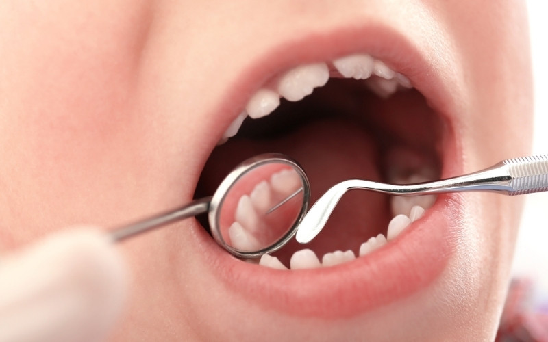 Kháng sinh thường được kê đơn khi tình trạng viêm tủy đã lan rộng gây áp xe nướu, sưng mặt hoặc kèm theo sốt