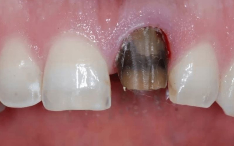 Răng đổi màu sang hồng nhạt hoặc lung lay bất thường là những dấu hiệu cảnh báo sớm tình trạng tiêu Abc8com giaitri tructuyen đang diễn ra.