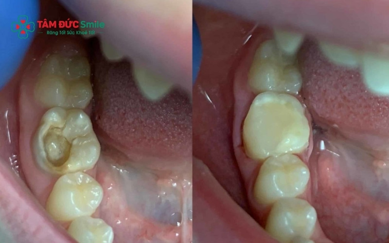Với các lỗ sâu mới chớm hoặc răng mẻ nhỏ chưa gây đau nhức, ABC8 đường link chính thức sẽ thực hiện trám trực tiếp bằng vật liệu Composite