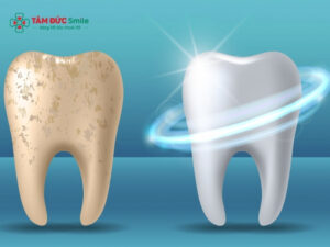 Tráng men răng là gì? Có nên thực hiện tráng men răng không?
