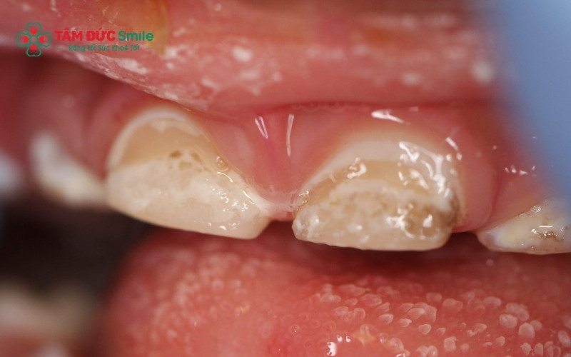 Sâu răng ở trẻ 1 tuổi đang có xu hướng gia tăng và cần được cha mẹ phát hiện sớm