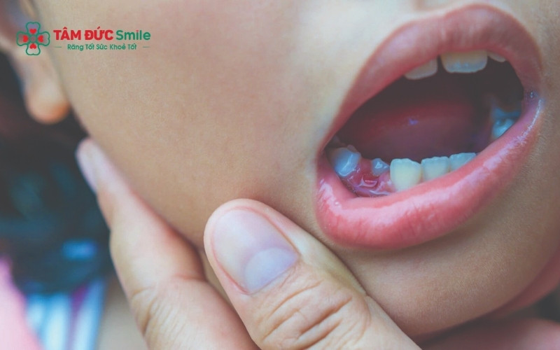 Răng sâu vỡ lớn gây đau nhức hoặc sưng nướu là những dấu hiệu tủy răng đã bị nhiễm trùng cần Abc8b tỷ lệ kèo World Cup 2026 ngay
