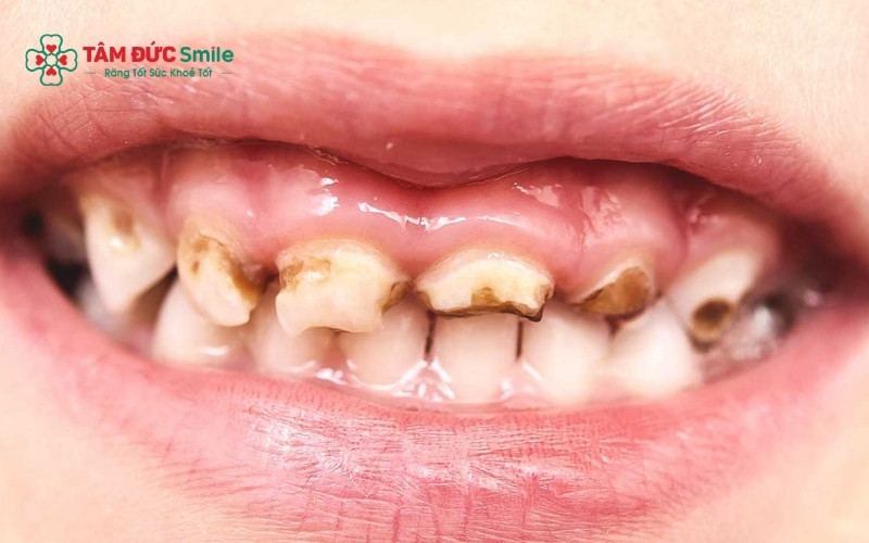 Điều trị tủy giúp bảo vệ mầm răng vĩnh viễn bên dưới không bị ảnh hưởng bởi vi khuẩn từ răng sữa bị viêm