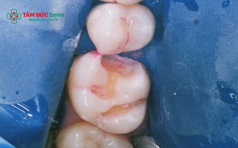 Chất Tannin trong lá bàng có tính sát khuẩn cao, giúp giảm viêm nhiễm vùng lợi, nhưng không thể phục hồi các mô răng đã bị vi khuẩn phá hủy