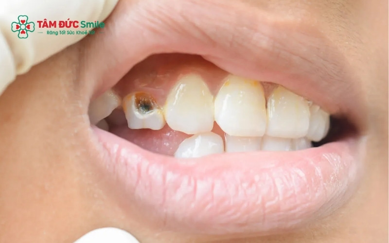 Lạm dụng nước lá bàng có thể gây xỉn màu men răng và khiến người bệnh chủ quan, dẫn đến tình trạng ABC88 com đăng nhập tiến triển nặng vào tủy