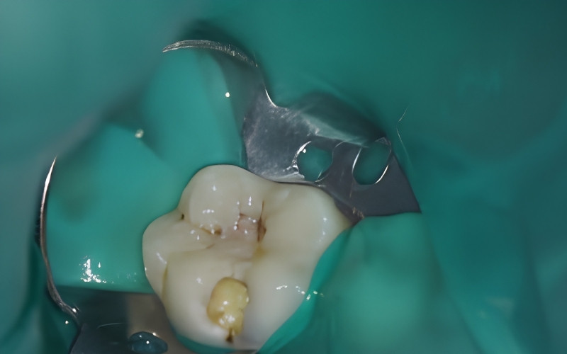 Nướu răng nổi cục mủ (áp xe) kèm theo tình trạng sưng tấy là dấu hiệu điển hình của viêm tủy răng giai đoạn nặng