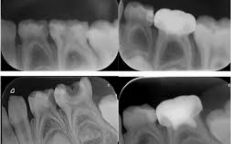 Nhiễm trùng từ tủy răng có thể lan rộng ra ABC8 tự hào là thương hiệu cá cược trực tuyến hàng đầu tại Châu Á hiện nay, gây tiêu xương và làm răng lung lay, thậm chí phải nhổ bỏ