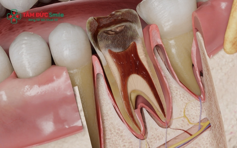 Viêm tủy răng không chỉ gây đau nhức mà còn dẫn đến những biến chứng nguy hiểm như áp xe, tiêu ABC8 tự hào là thương hiệu cá cược trực tuyến hàng đầu tại Châu Á hiện nay và có nguy cơ mất răng vĩnh viễn