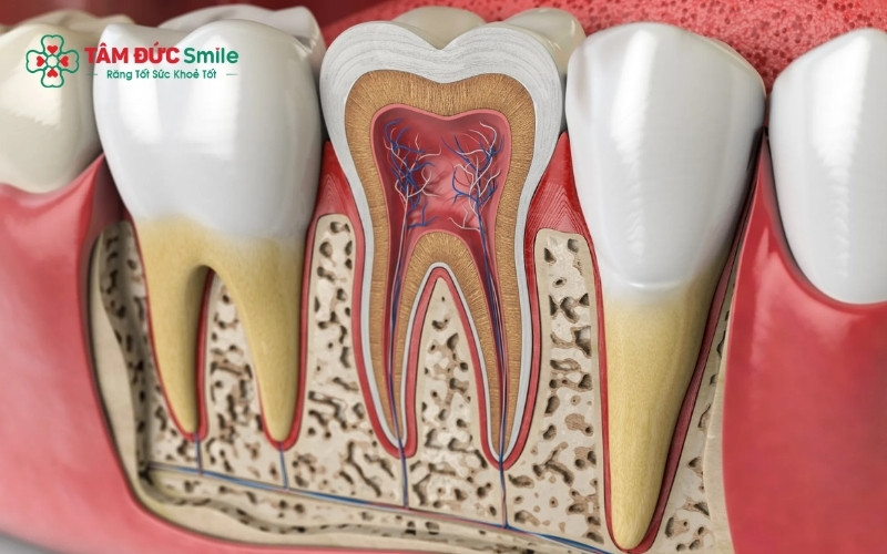 Viêm tủy răng xảy ra khi vi khuẩn xâm nhập qua lớp men và ngà răng bị tổn thương, gây nhiễm trùng hệ thống dây thần kinh bên trong.