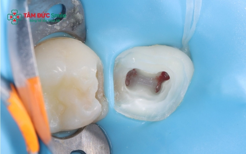 Khi viêm tủy chuyển sang giai đoạn cấp tính, những cơn đau nhức dữ dội sẽ xuất hiện tự nhiên