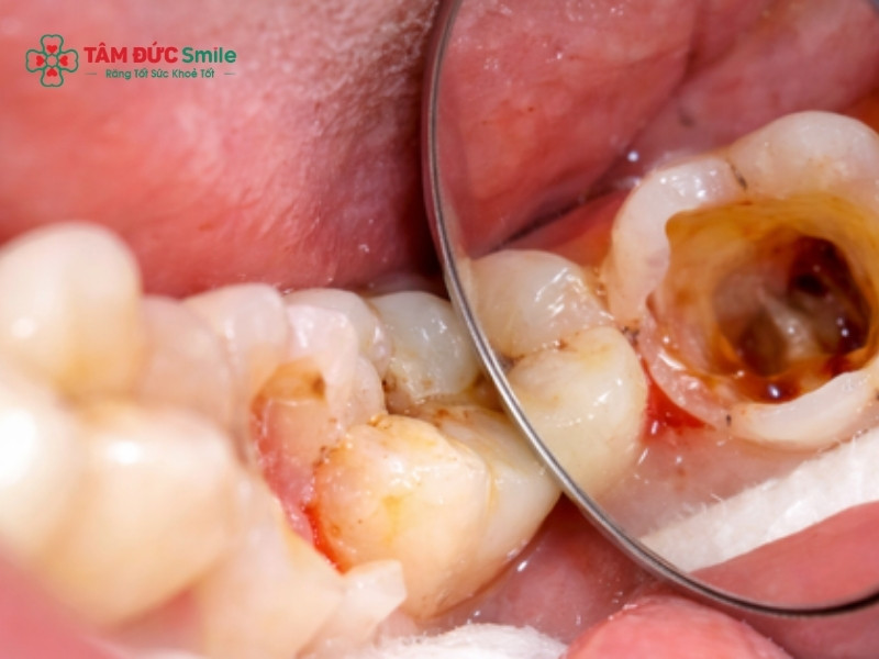 Viêm tủy răng có nguy hiểm không? Giải đáp chi tiết