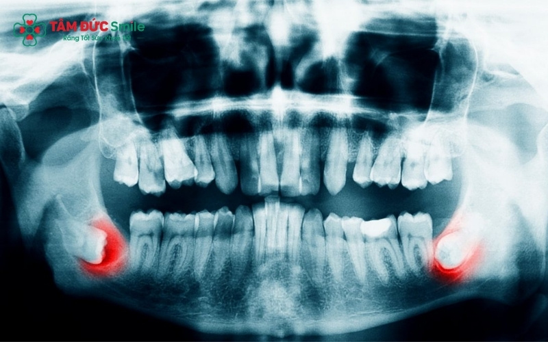 Phim X-quang là "chìa khóa" giúp ABC8 đường link chính thức xác định chính xác vị trí mầm răng khôn.