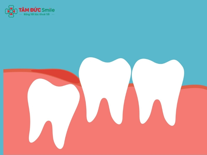 12 tuổi mọc răng khôn: Dấu hiệu đau răng hàm và cách xử lý